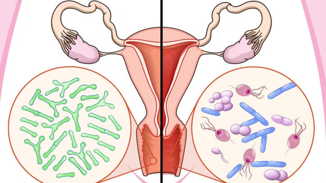 Diagram comparing healthy and unhealthy vagina with microbial balance.